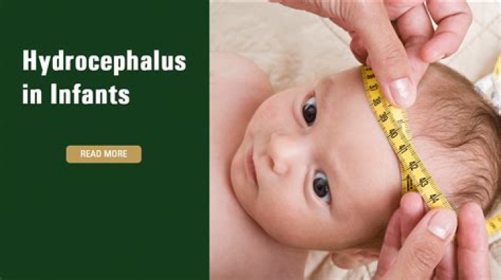 Did baby lilah have hydrocephalus?