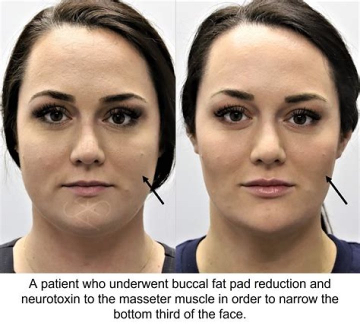 How much is buccal fat pad removal?
