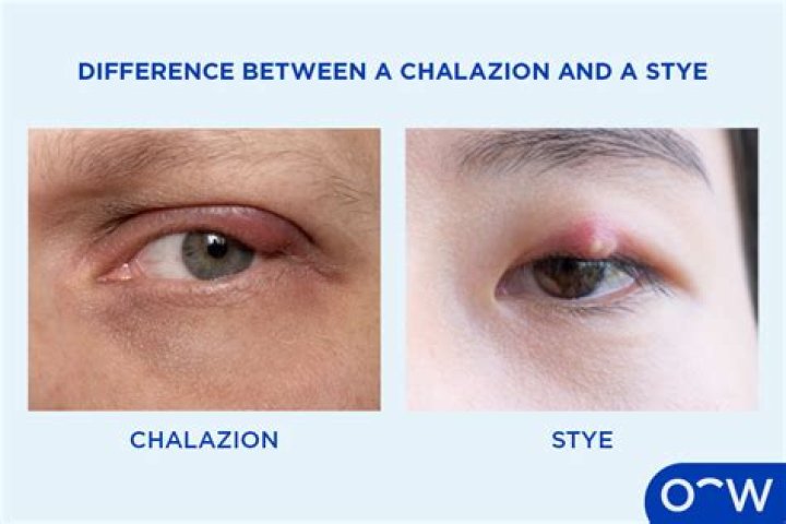 Why do you get chalazion?