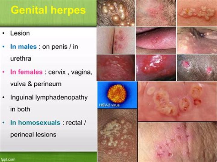 Will genital herpes go away untreated?